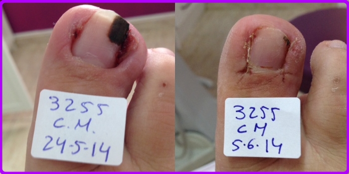 Tratamiento de uñas encarnadas en Clinica de Podologia El Palmar